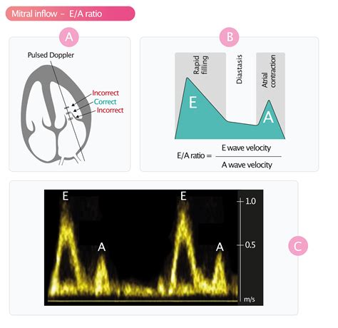 lv function normal with lvedp 6mmhg|The assessment of left ventricular diastolic function: guidance and .